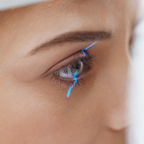 Imagenes secundarias – Cirugía refractiva con láser 3